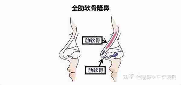 深圳美莱梁晓健：科普全肋骨鼻和半肋骨鼻的区别