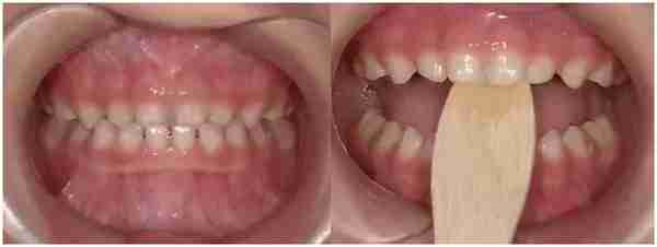 孩子的嘴巴“地包天”需要治疗吗？