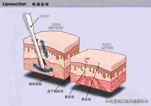 抽脂必读！抽脂手术知多少