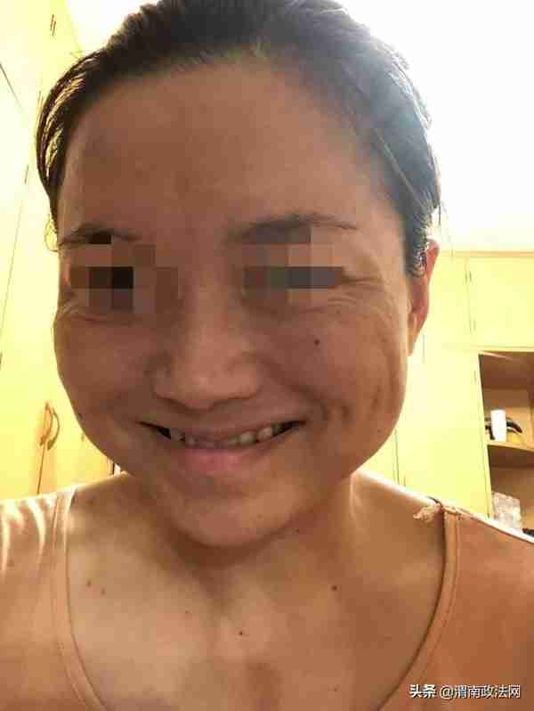 女子被瘦脸针“毁容”之后：一针下去，整张脸就垮了