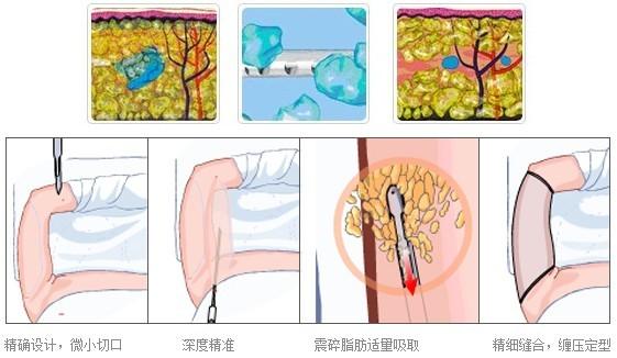 吸脂瘦手臂会不会反弹