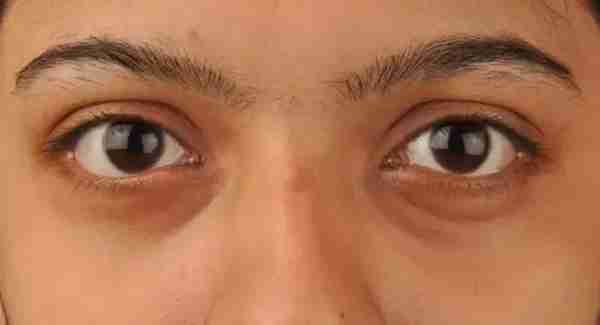 壹知肤：存在已久的黑眼圈，还有可能彻底消除吗？