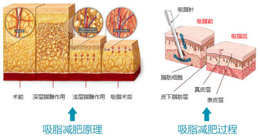 吸脂瘦手臂会不会反弹