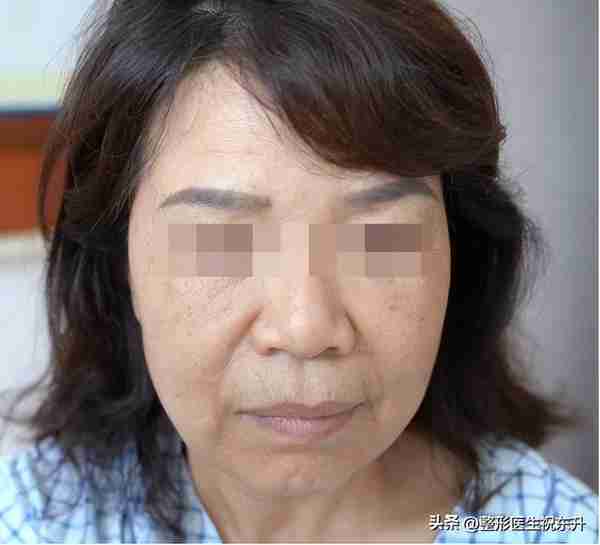62岁到北京把拉皮手术做了，15天后忍不住吐槽这“3件事”!