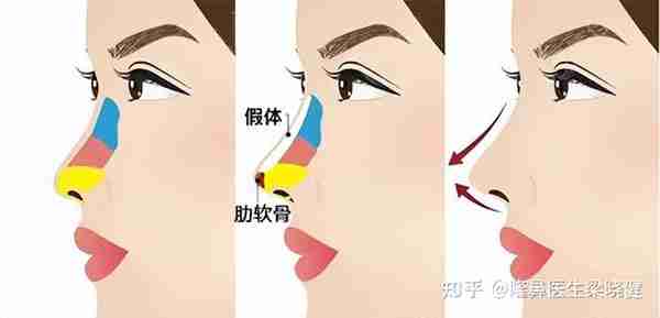 深圳美莱梁晓健：科普全肋骨鼻和半肋骨鼻的区别