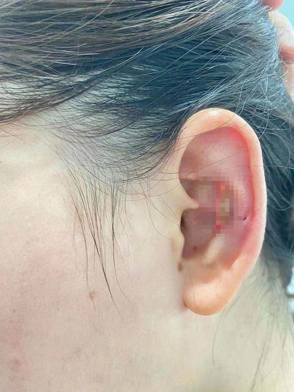 女子取耳软骨隆鼻致耳组织坏死，整形医院：先治疗，会恢复的
