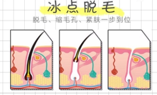 冰点脱毛手术过程需要多长时间