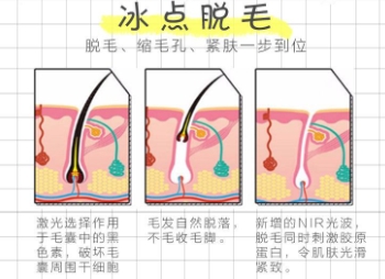 冰点脱毛真的有恢复期吗